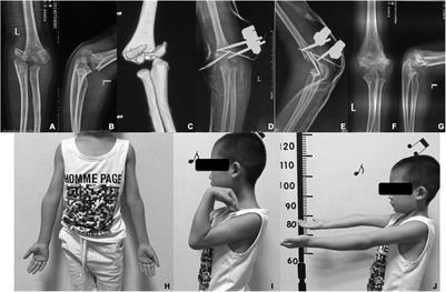 Treatment of Pediatric Intercondylar Humerus Fracture With External Fixation and Percutaneous Pinning After Closed Reduction